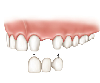 bridge-durham-dentist