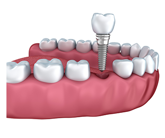 dental-implant-durham-dentist