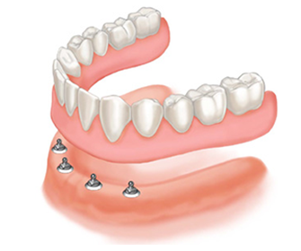 denture-durham-dentist