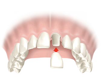 implant-durham-dentist
